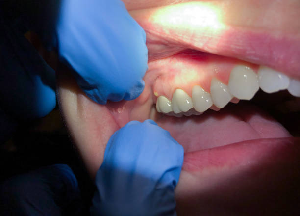 Best Emergency Wisdom Teeth Removal in Hampden Sydney, VA